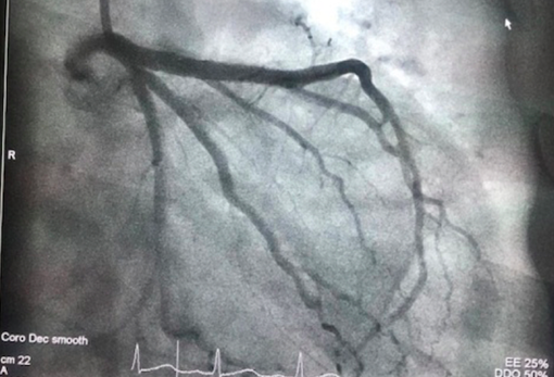 Cứu sống một bệnh nhân U100 bị nhồi máu cơ tim cấp